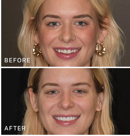 Smile Transformations: Before and After